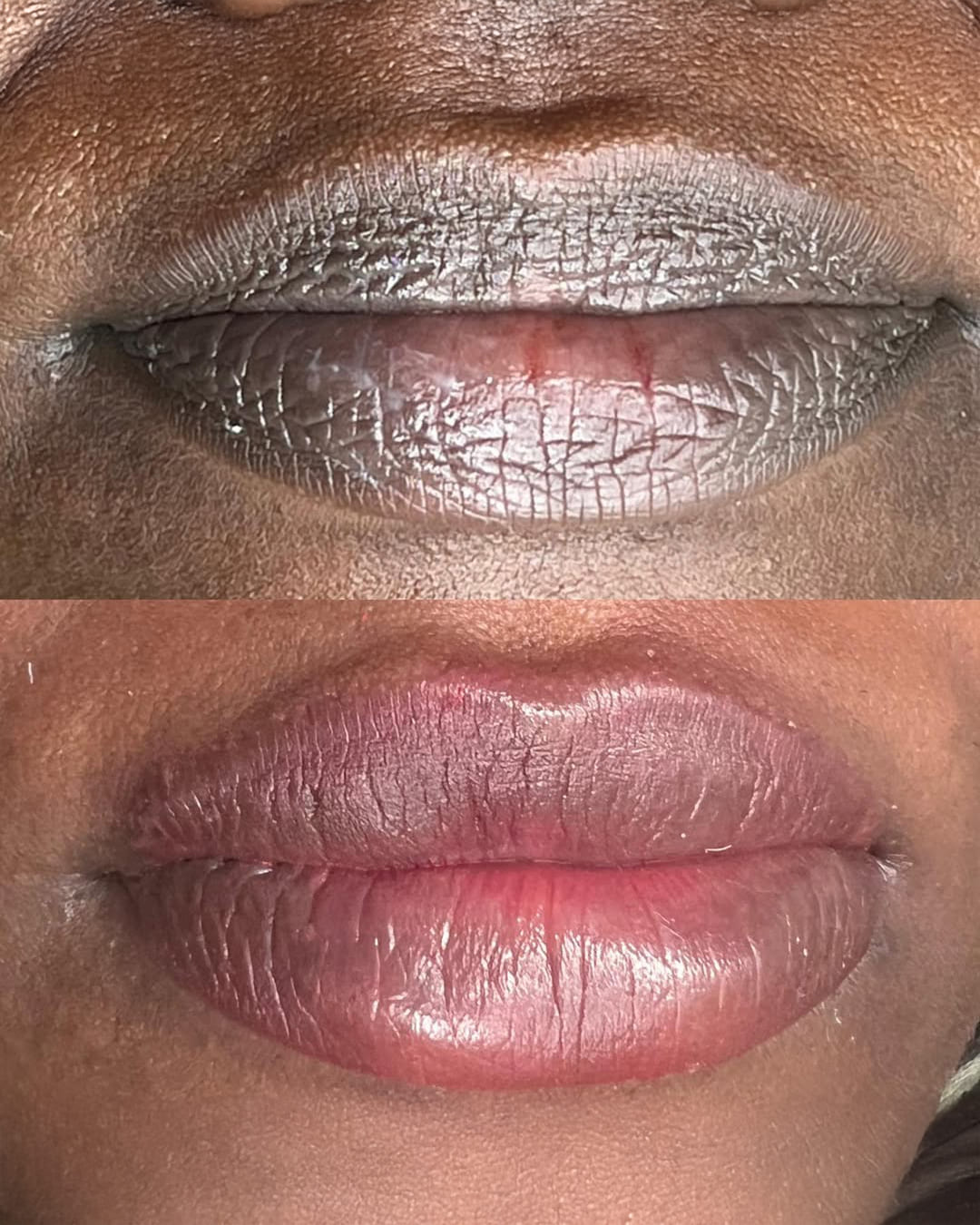 Dark Lip Neutralization